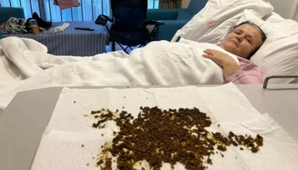 «اكتشاف غير مسبوق: أطباء يكتشفون 20 ألف حصوة في مرارة امرأة»